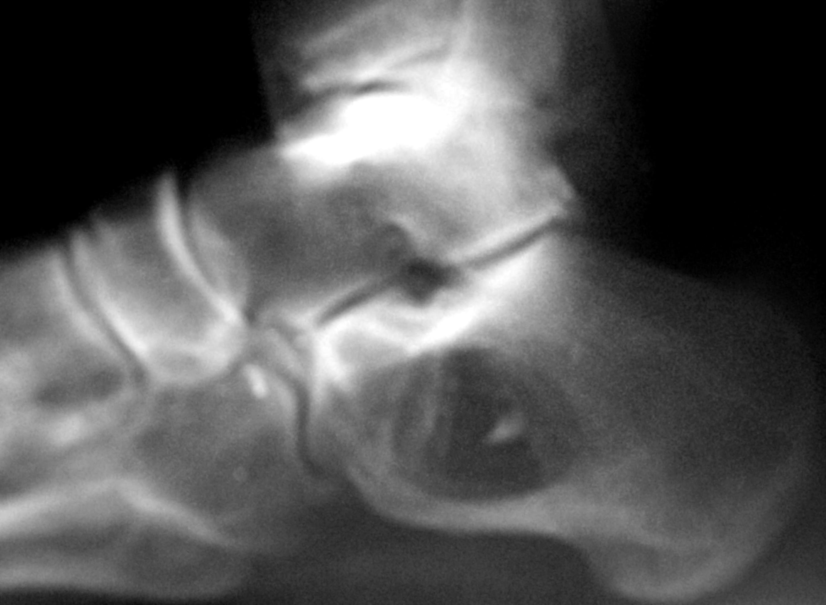 Pathology Outlines Solitary Bone Cyst 6007